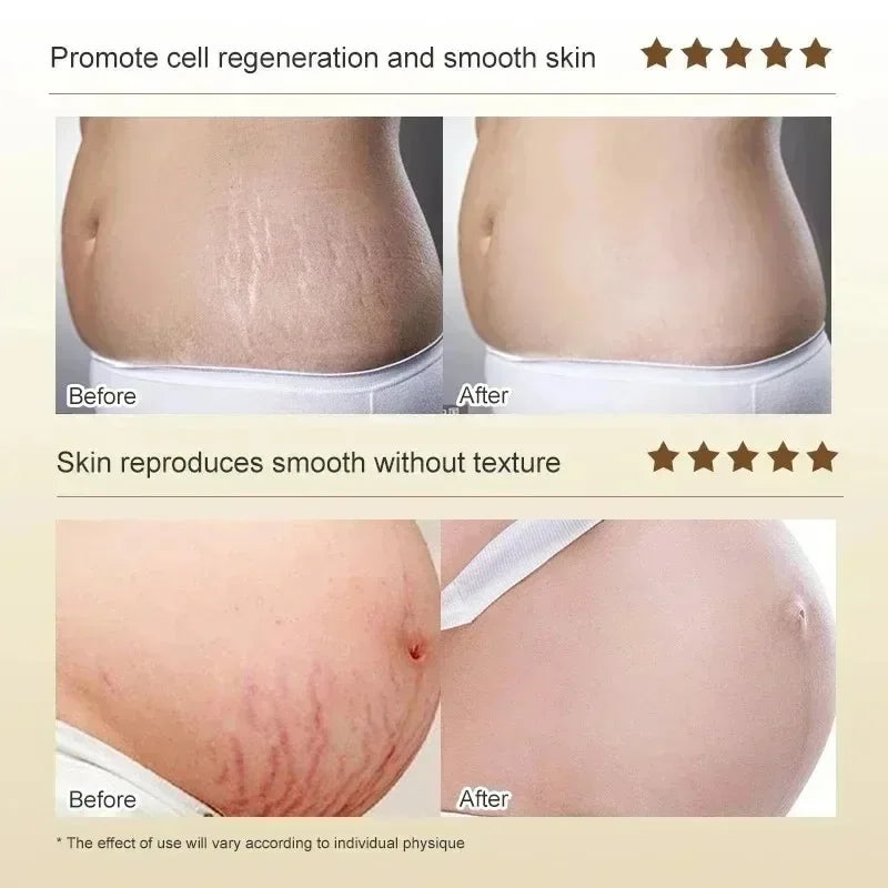 Crème Effacement Vergetures Rouges & Blanches – Anciennes & Récentes | Soin Grossesse & Post-Partum
