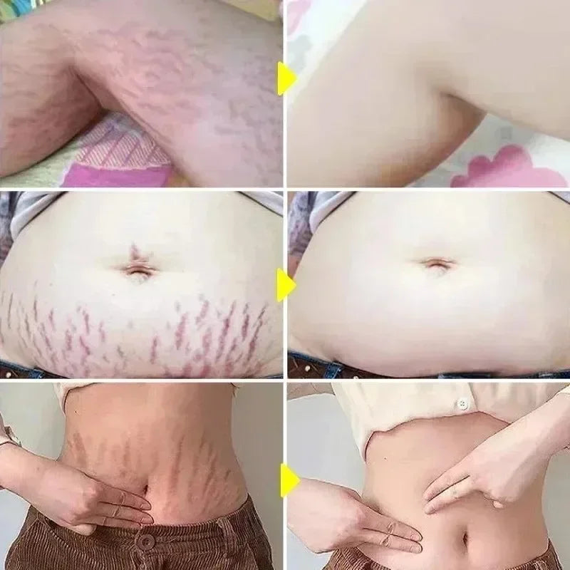 Crème Effacement Vergetures Rouges & Blanches – Anciennes & Récentes | Soin Grossesse & Post-Partum