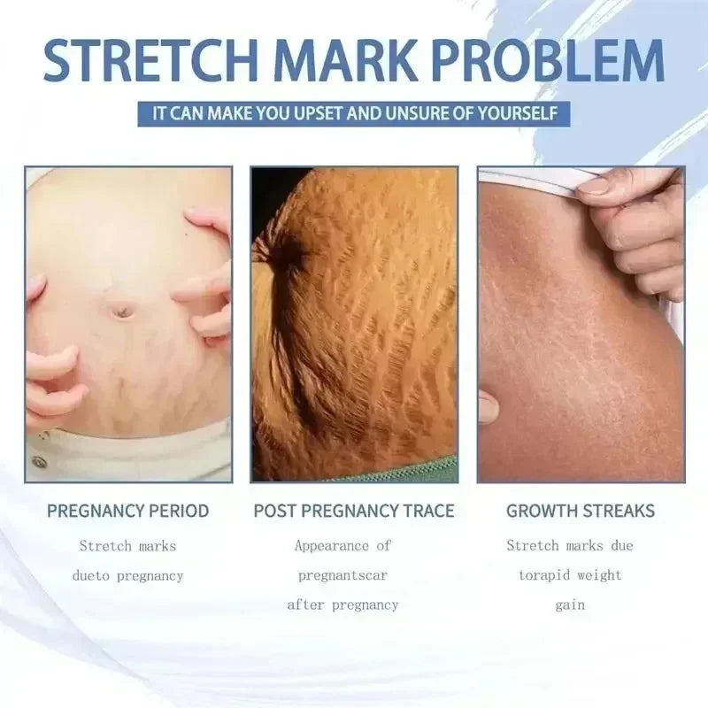 Crème Effacement Vergetures Rouges & Blanches – Anciennes & Récentes | Soin Grossesse & Post-Partum