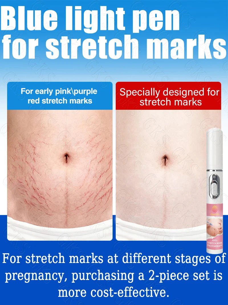 Appareil Laser Anti-Vergetures — Stylo Lumière Bleue Soin Peau Maternité & Post-Partum