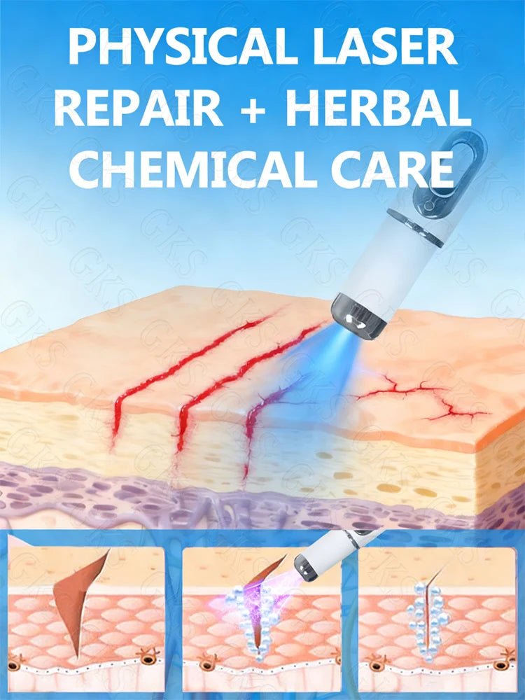 Appareil Laser Anti-Vergetures — Stylo Lumière Bleue Soin Peau Maternité & Post-Partum