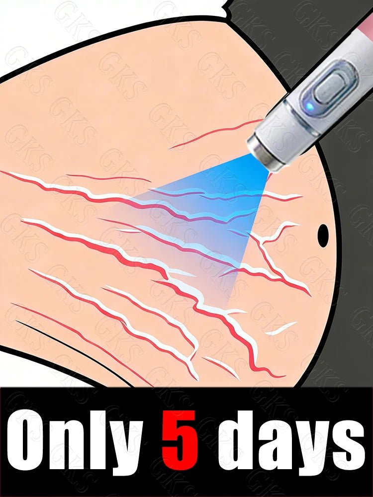 Appareil Laser Anti-Vergetures — Stylo Lumière Bleue Soin Peau Maternité & Post-Partum
