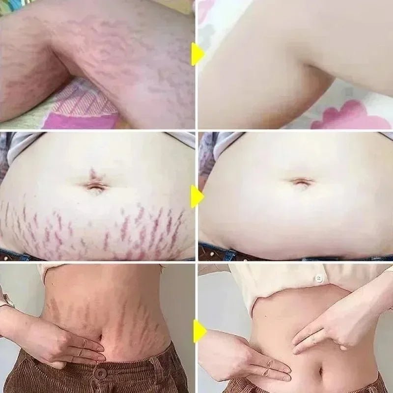 Crème Effacement Vergetures Rouges & Blanches – Anciennes & Récentes | Soin Grossesse & Post-Partum